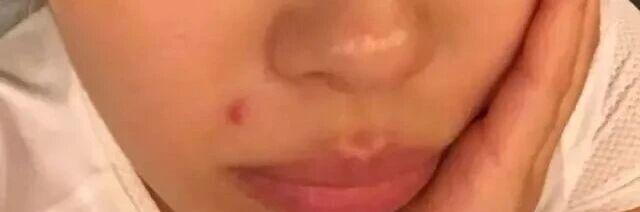 Holiday breakouts? Travel bad face? Dermatologists teach you three days to rejuvenate