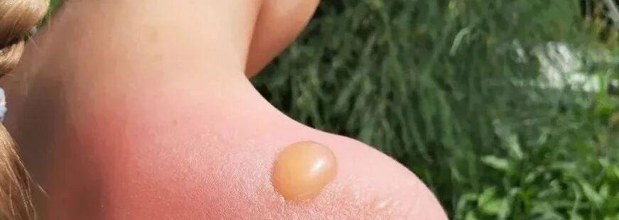 Why do you get sunburned when you clearly wear sunscreen?