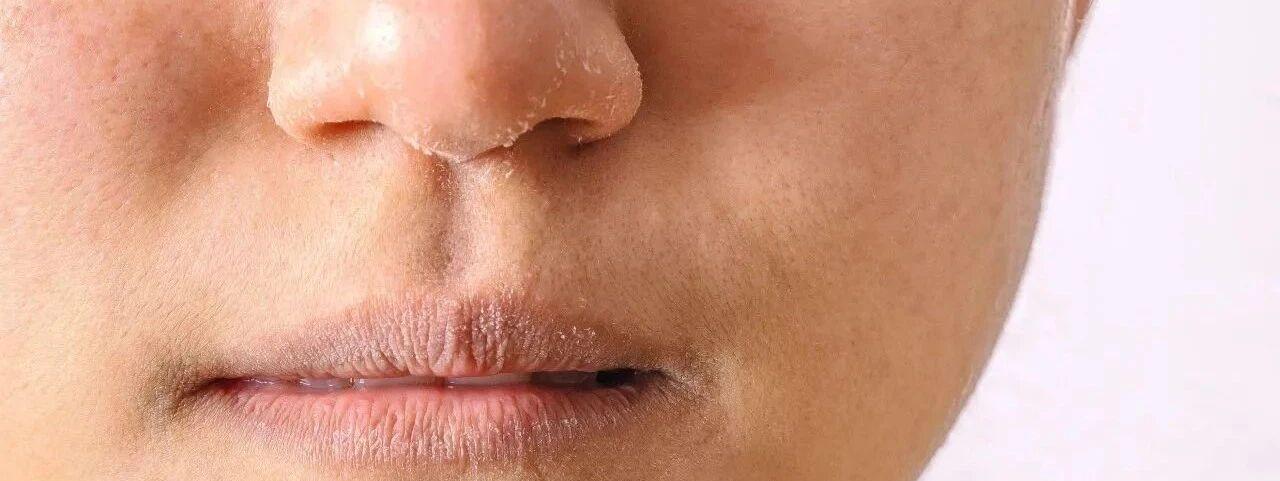 Indoor skin is dry in winter, is it useful to turn on a humidifier? -